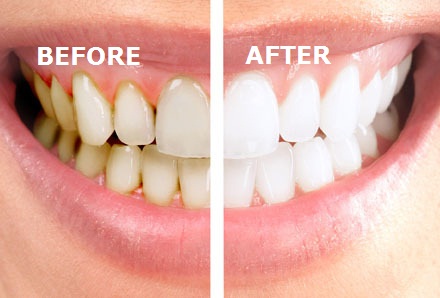 doel Ver weg Categorie Zelf tandsteen verwijderen doe je zó! | 10 Tips. | Tandsteen verwijderen? |  10 Tips en middelen!